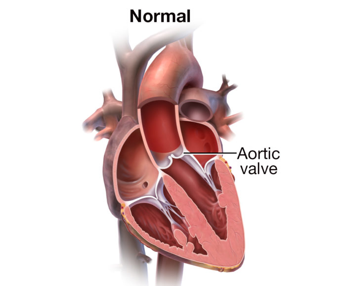 Aortic Valve Regurgitation