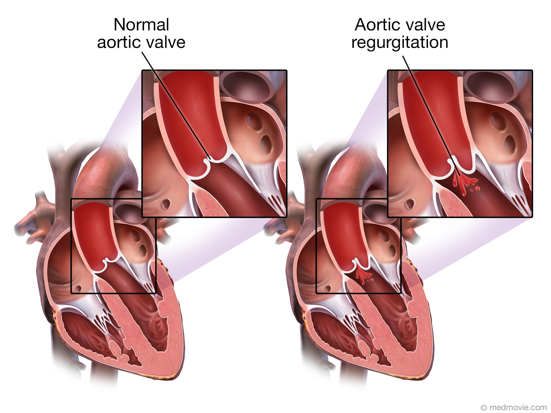Dissertation on aortic regurgitation