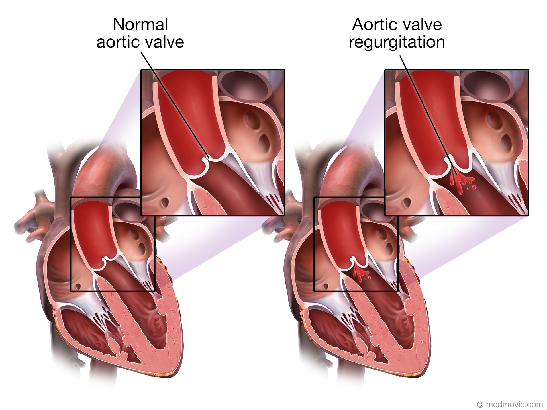 Heart Valve Insufficiency Icd 10