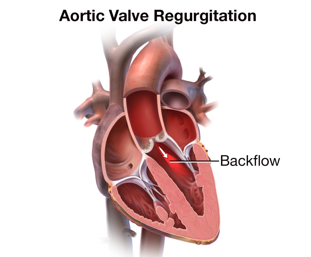 Aortic Valve Regurgitation