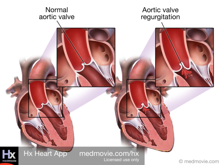Aortic Valve Regurgitation