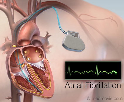 Pacemaker – Dual Chamber