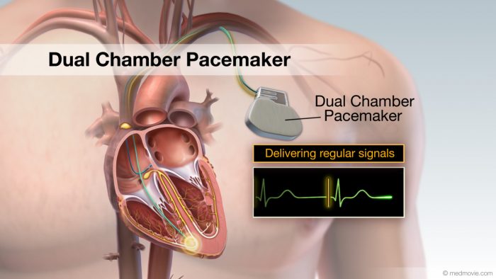 Pacemaker – Dual Chamber