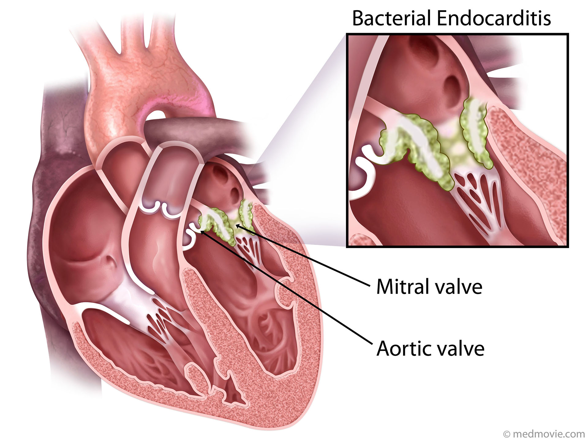 What Is Chronic Bacterial Endocarditis