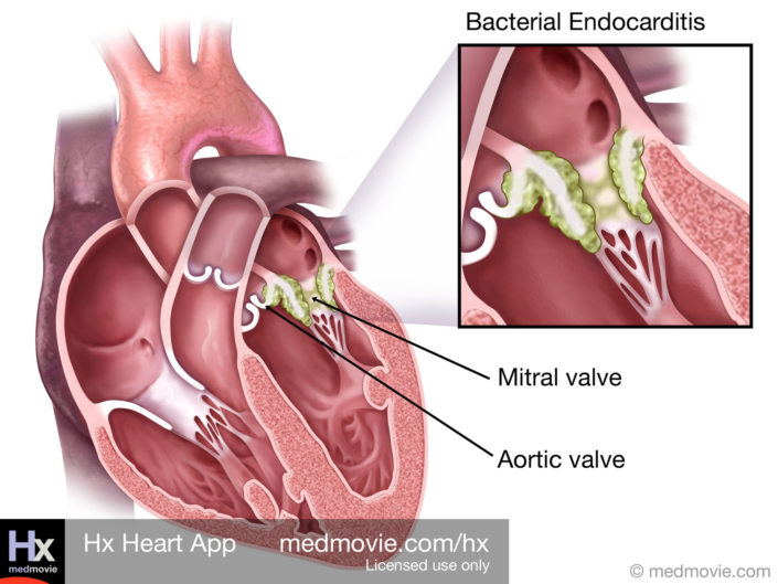 Bacterial Endocarditis