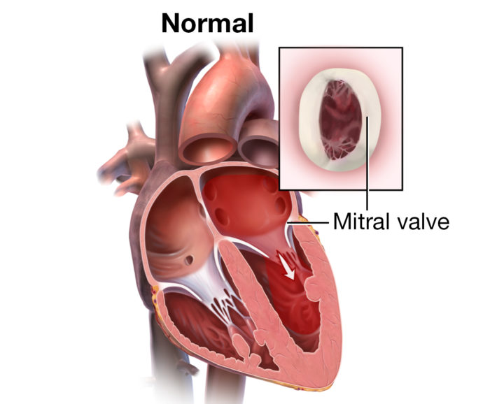 Mitral Valve Stenosis