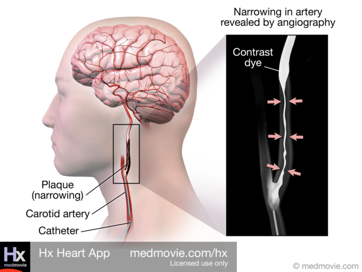 Carotid Angiography