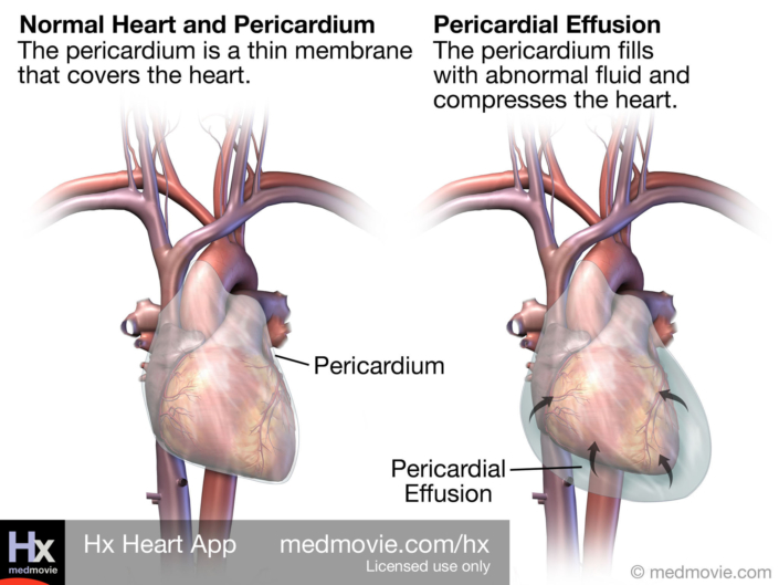 Pericardial Effusion