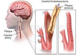 Carotid Artery Surgery