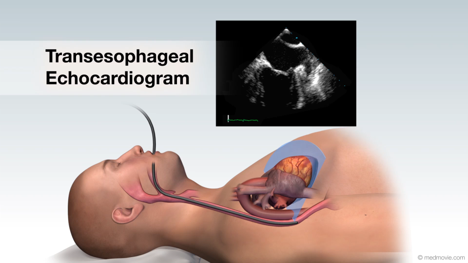 Transesophageal Echocardiogram