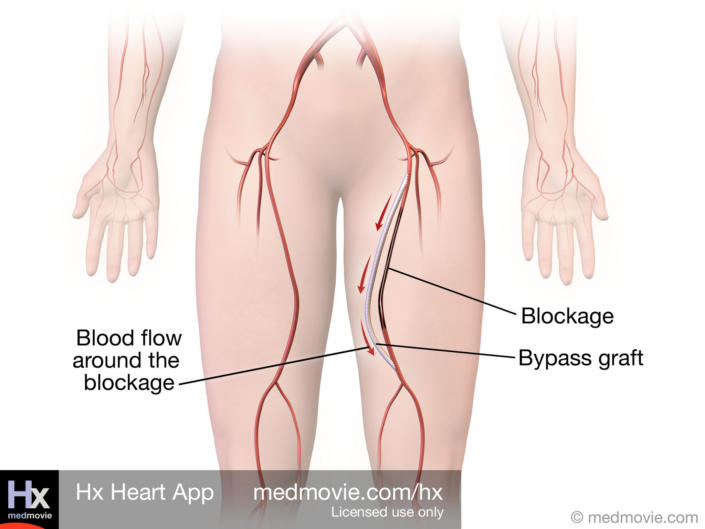 Peripheral Bypass Surgery