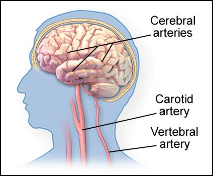 Hemorrhagic Stroke