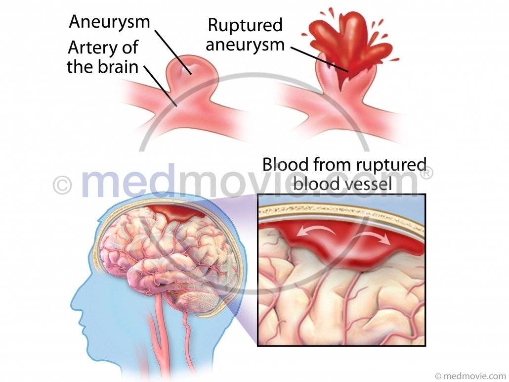 hemorrhagic-stroke-and-ruptured-aneurysm-medmovie