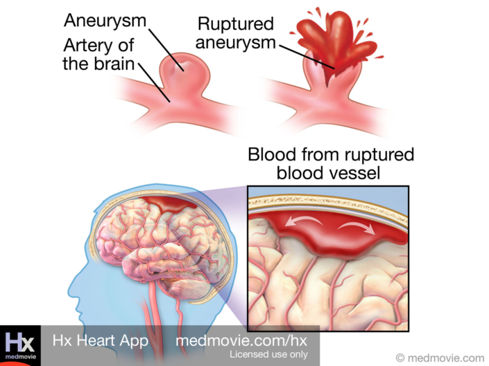 Hemorrhagic Stroke