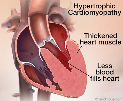 Hypertrophic Cardiomyopathy