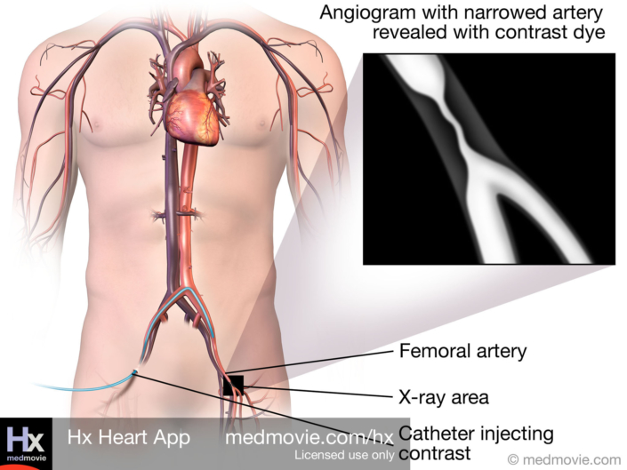 Peripheral Angiogram