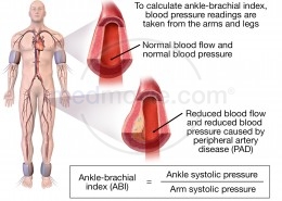 Ankle-Brachial Index