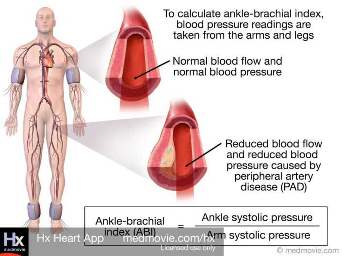 Ankle-Brachial Index
