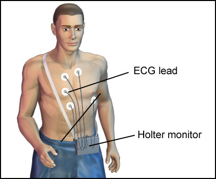 Holter Monitor