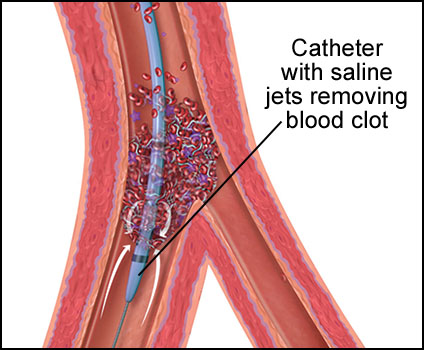 Peripheral Vascular Angiojet Thrombectomy