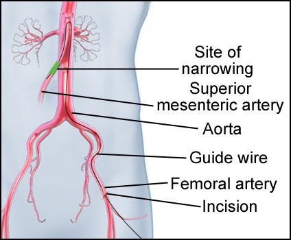 Mesenteric Artery Stent