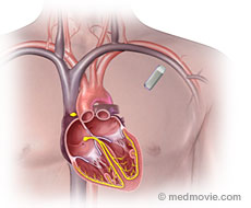 Delayed Total Atrioventricular Block After Transcatheter Aortic Valve  Replacement Assessed by Implantable Loop Recorders