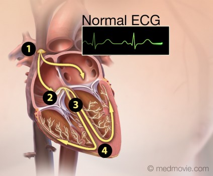 RVOT Ventricular Tachycardia