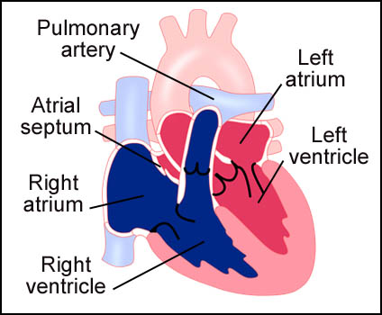 Patent Foramen Ovale