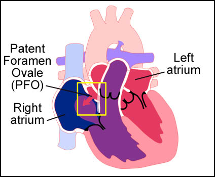 Patent Foramen Ovale