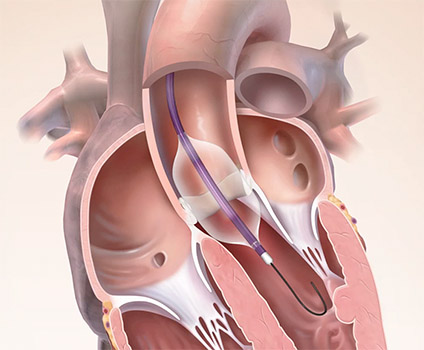 Aortic Valvuloplasty