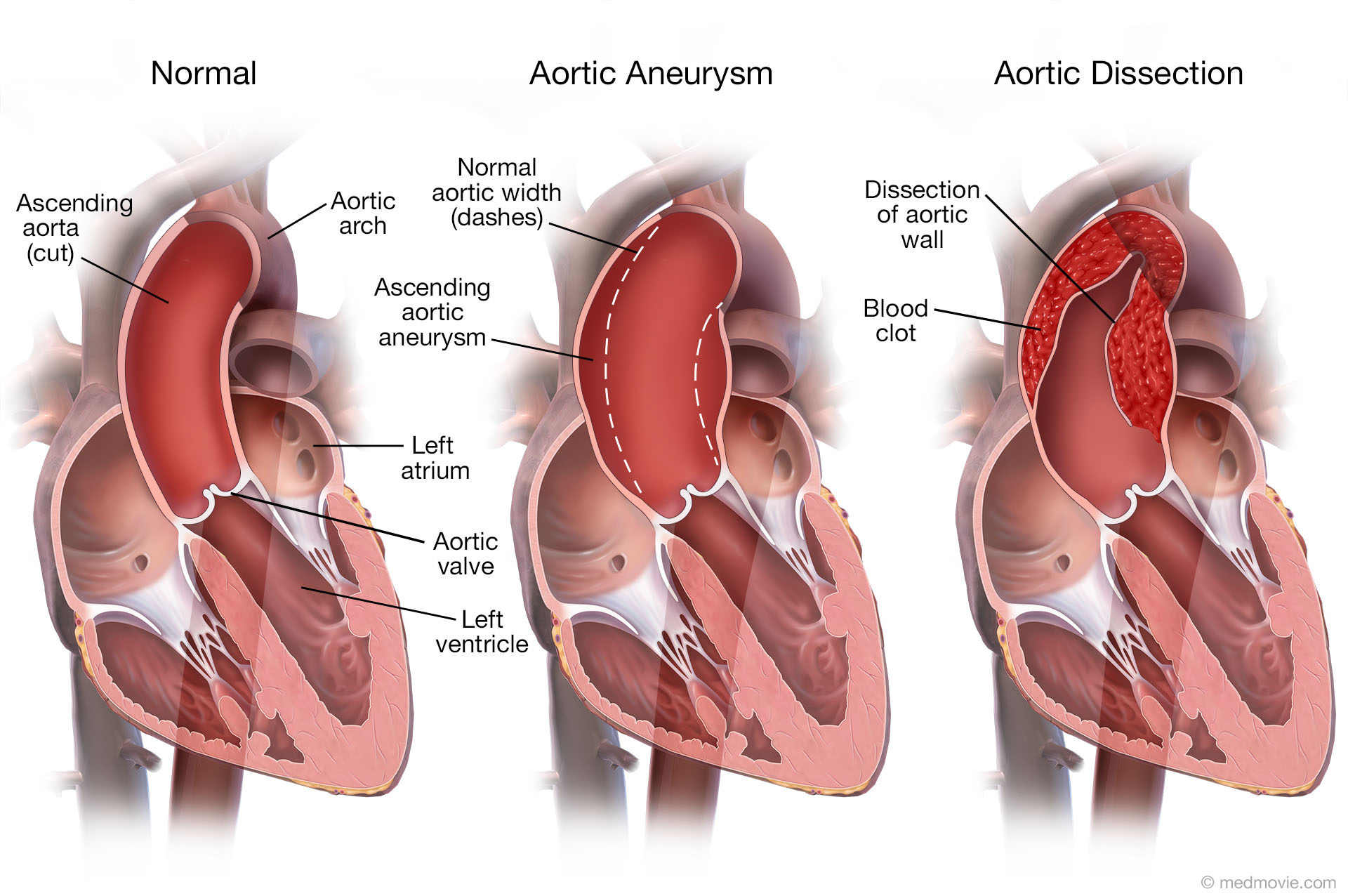 Aortic Aneurysm And Aortic Dissection 