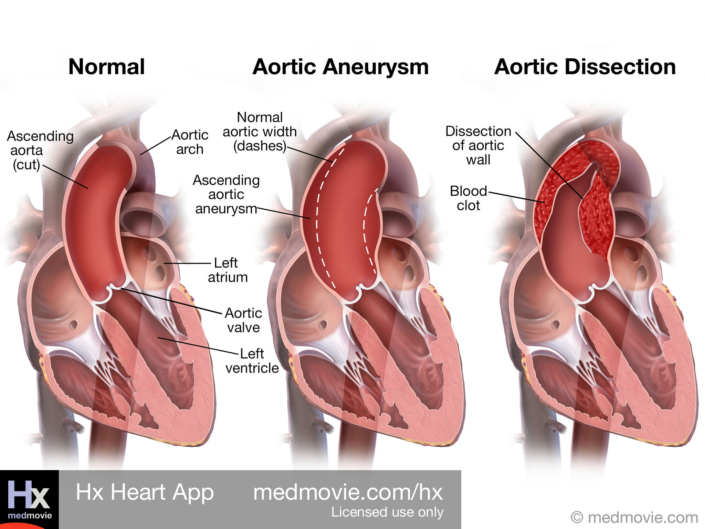 Aortic Aneurysm and Aortic Dissection