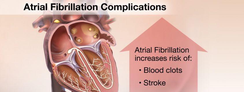 Atrial Fibrillation Complications – Medmovie.com