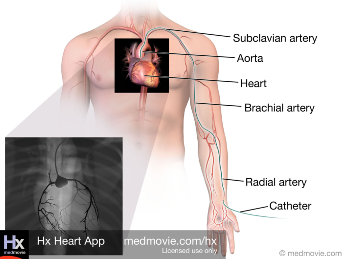 Radial Access Cardiac Catheter