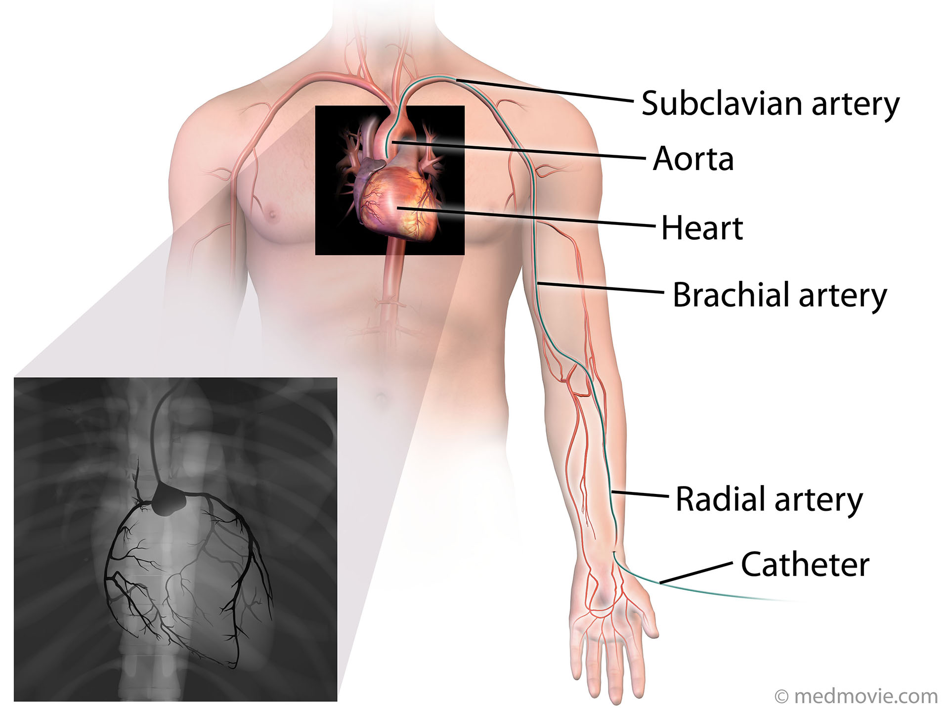 Radial Cardiac Catheter