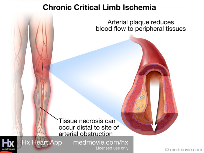 Chronic Critical Limb Ischemia