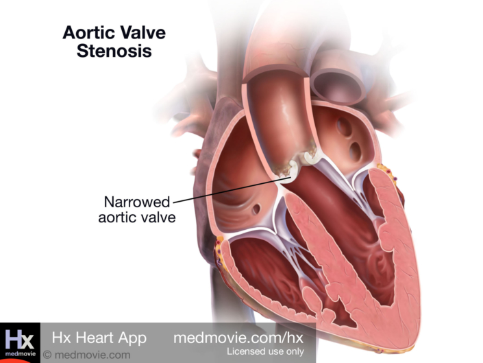 Aortic Valve Stenosis