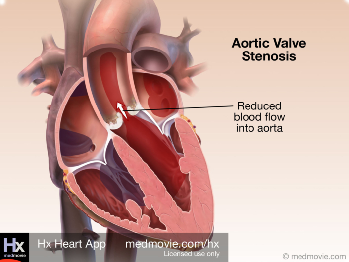 Aortic Valve Stenosis