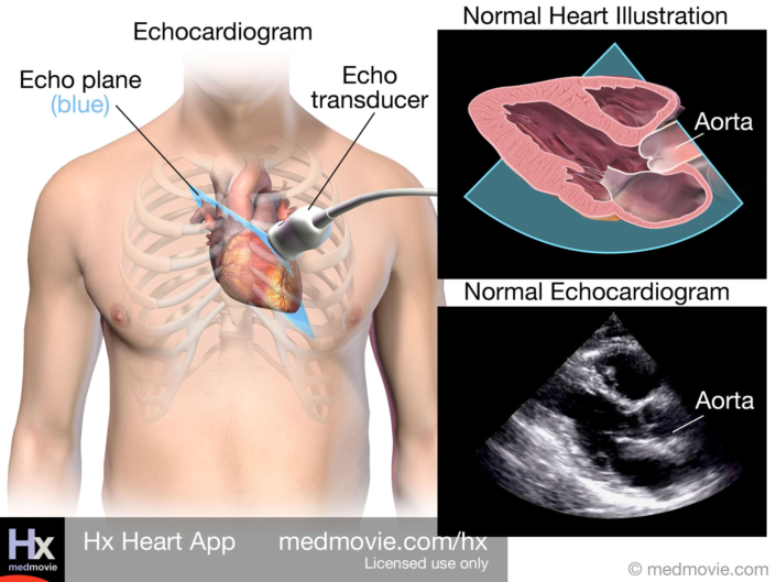 PLAX Ultrasound
