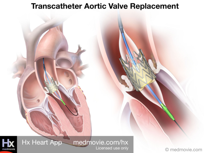 Transcatheter Aortic Valve Replacement