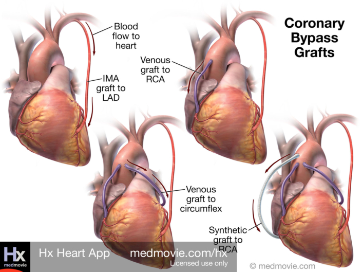 Coronary Artery Bypass Grafts
