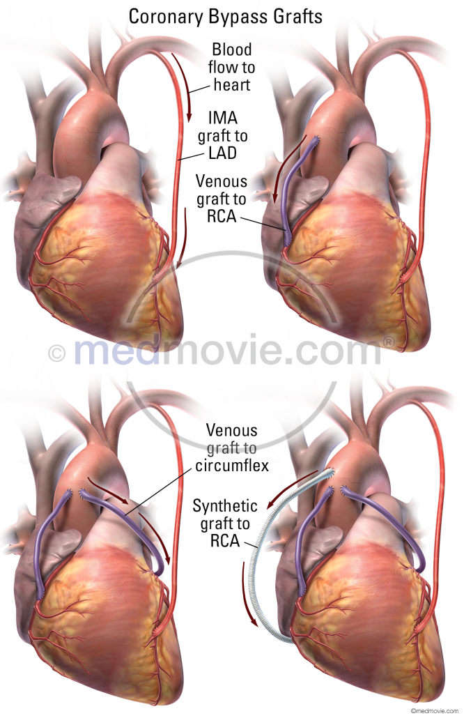 Coronary Bypass Grafts