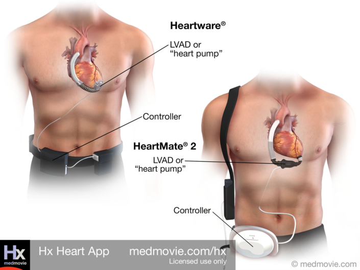 Left Ventricular Assist Devices