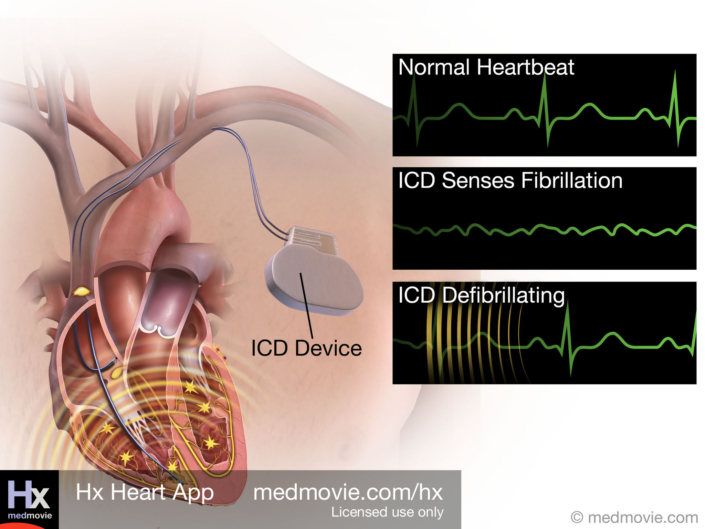 Implantable Cardioverter Defibrillator