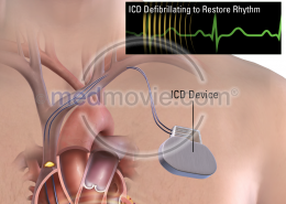 ICD Device