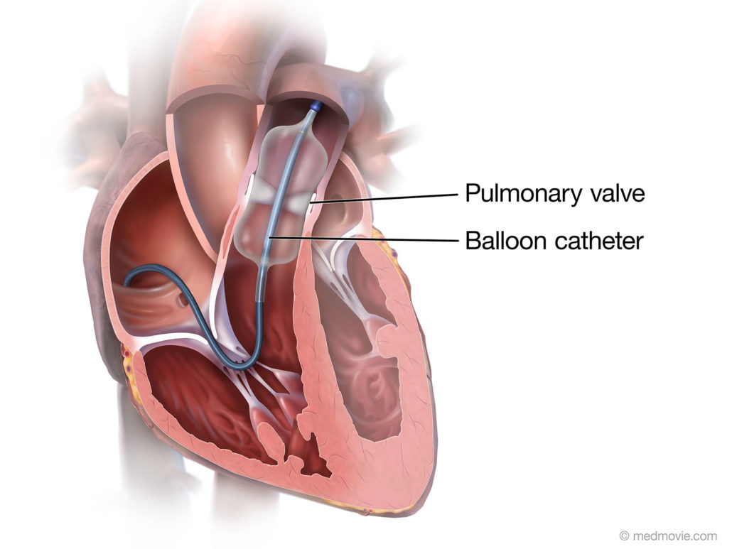 Pulmonary Valve Angioplasty