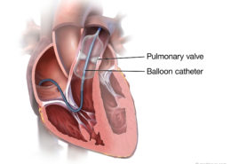 Pulmonary Valve Angioplasty