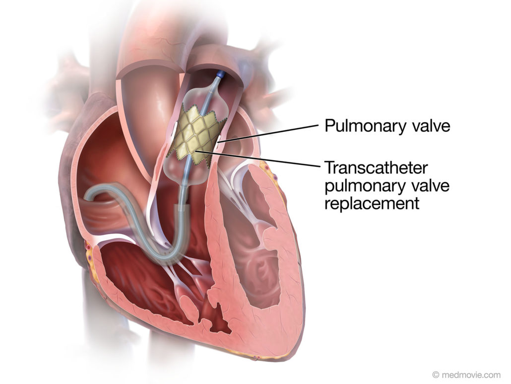 Transcatheter Pulmonary Valve Replacement