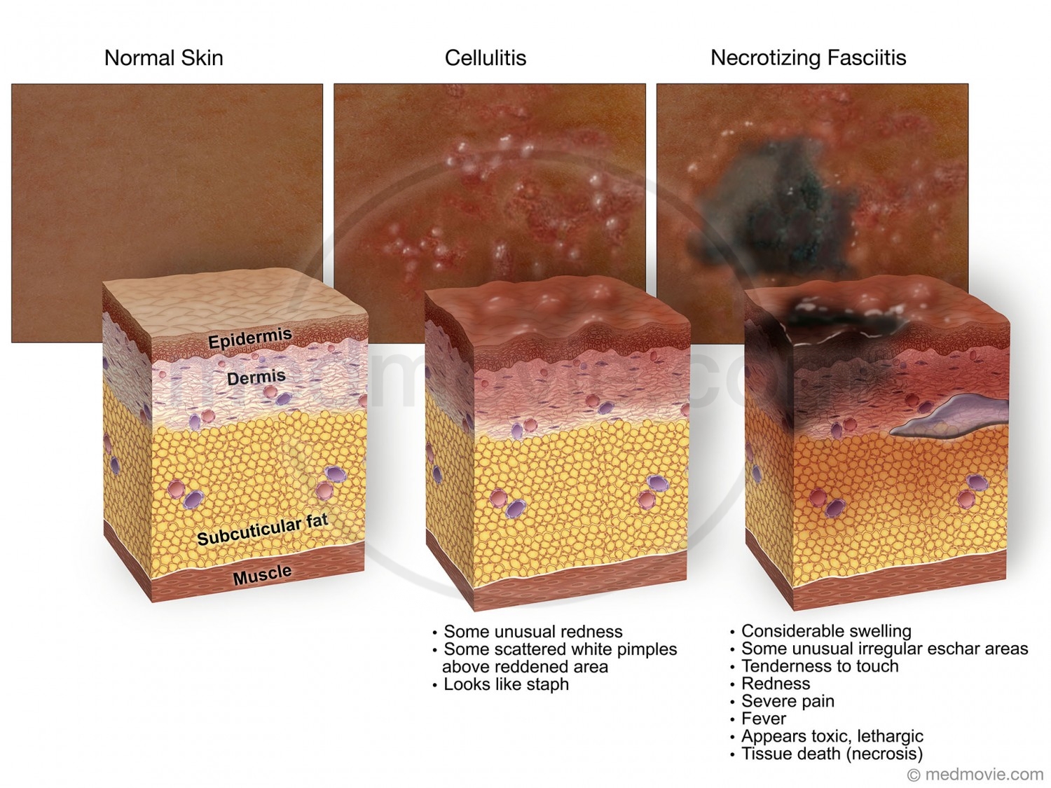 Necrotizing Fasciitis – Medmovie.com