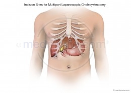 Incision Sites for a Multiport Laparoscopic Cholecystectomy